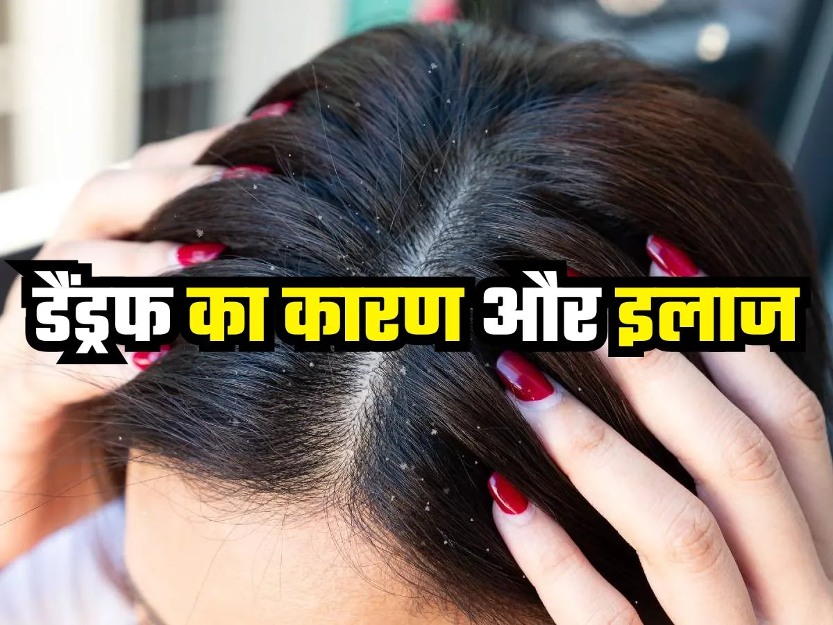 Dandruff Tips