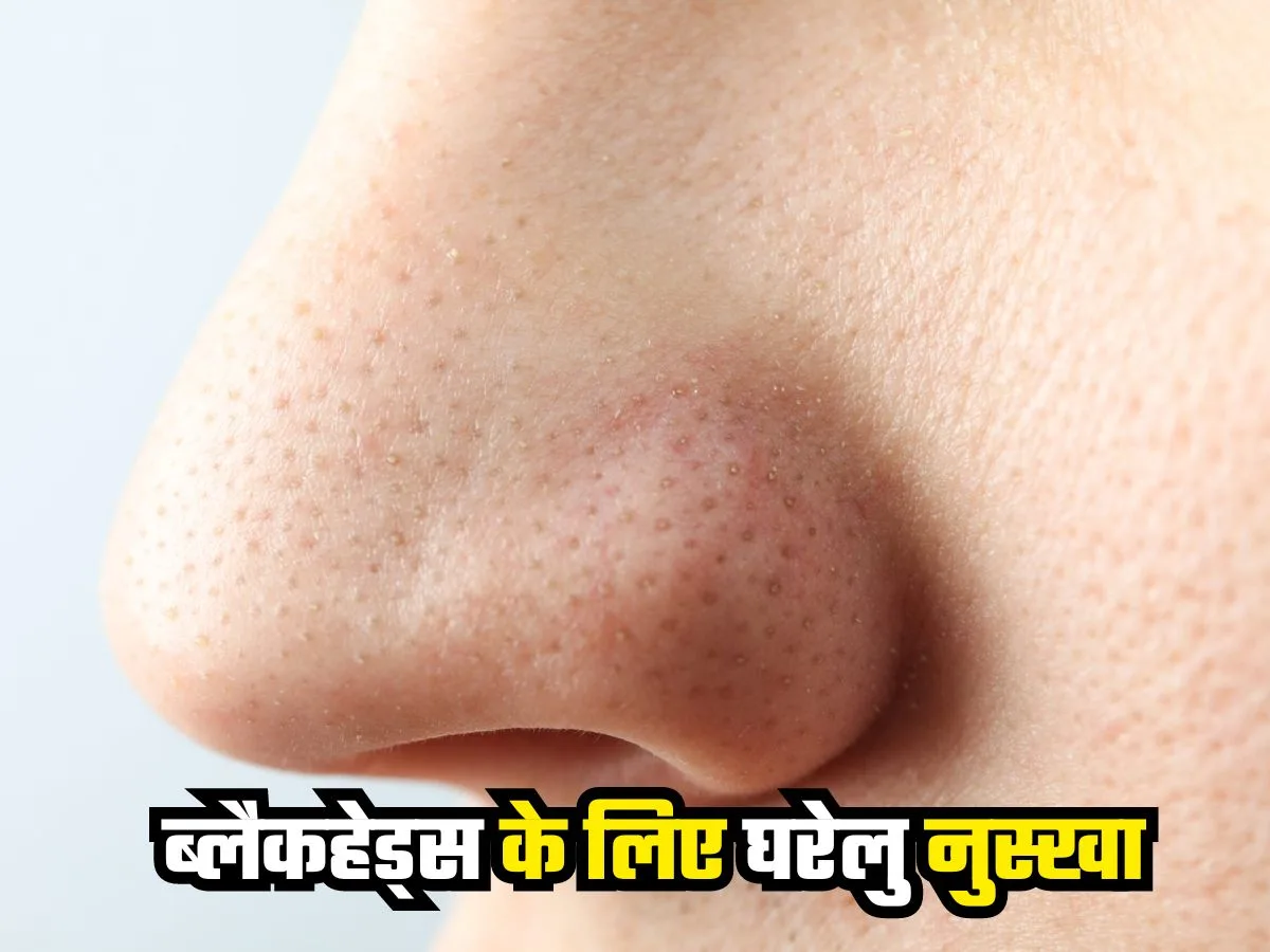 Blackheads home remedies